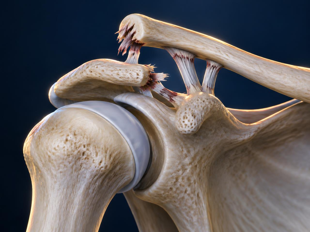 Artrose e lesões da acromioclavicular: a lesão em detalhe