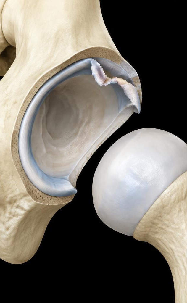 Lesão do labrum
