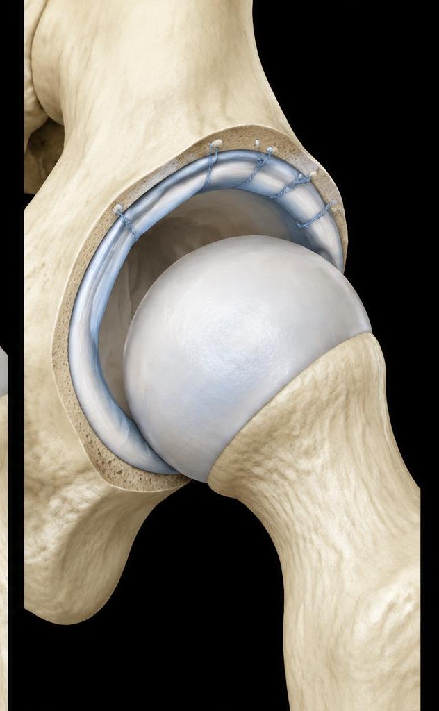 Reparo do lábio acetabular: abordagem do tratamento