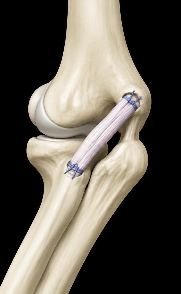 Reparo de lesões ligamentares: abordagem do tratamento